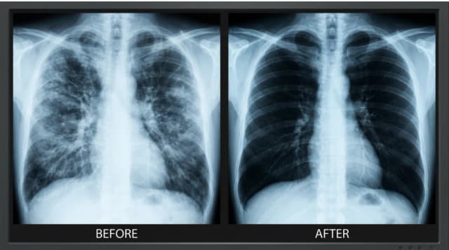 PulmoClean BioCare